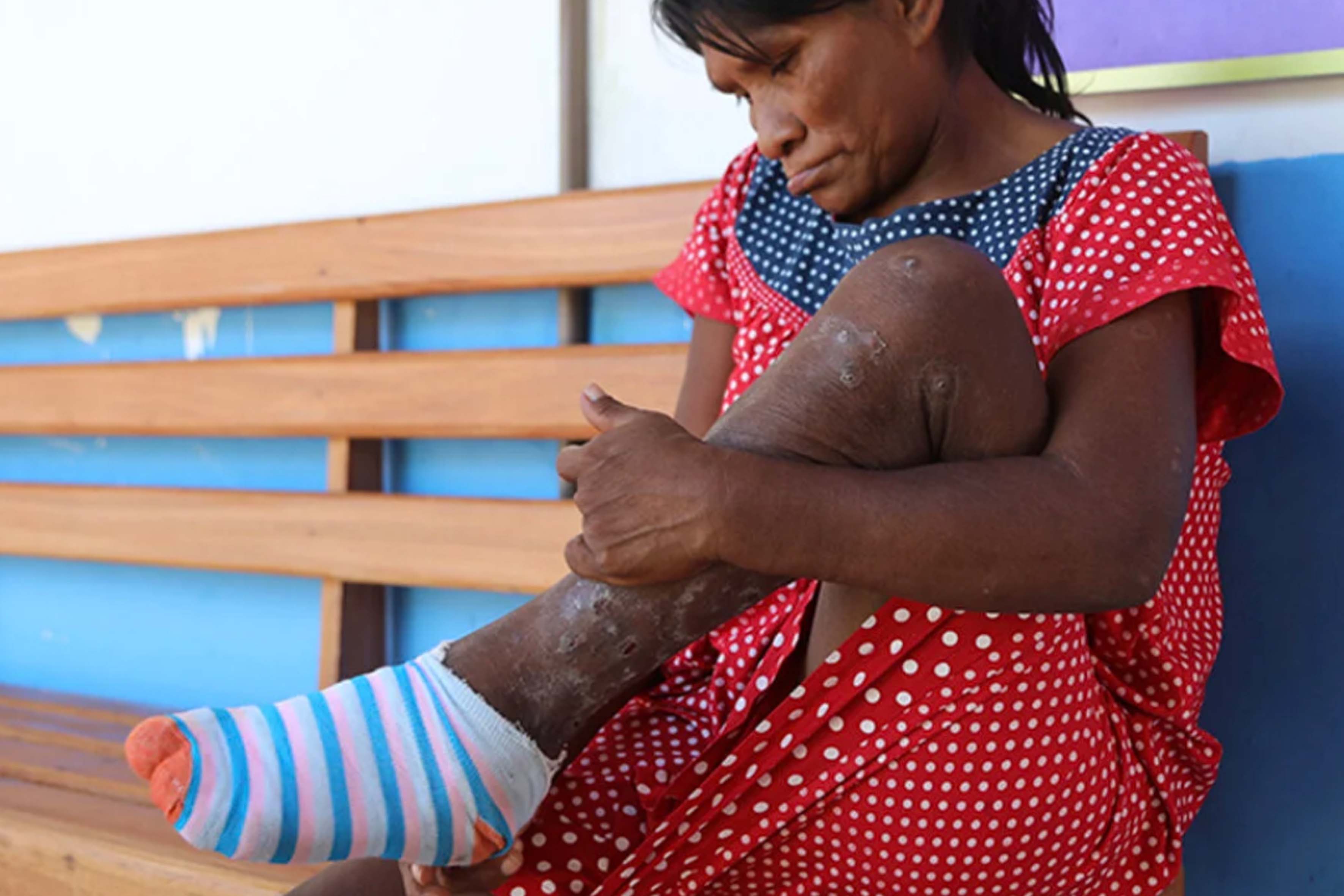 Tungiasis-and-the-guardians-of-the-Amazon-Pan-American-Health-Organization Tungiasis and the guardians of the Amazon